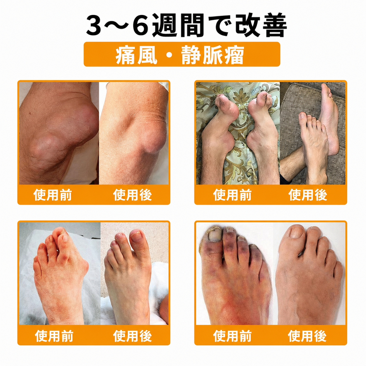 3〜6週間で改善 痛風・静脈瘤 使用前・使用後 日本語版